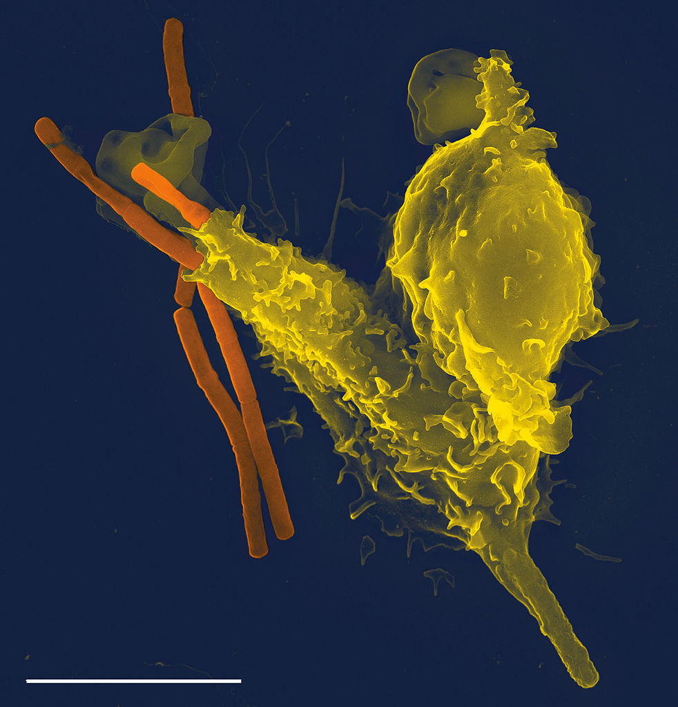 Scanning electron microscope image of a neutrophil, a cell from the innate immune system (yellow), engulfs anthrax bacteria (orange); scale bar = 5 micrometres.   Body cells that experience stress, wounding, or sense the presence of bacteria, produce cytokines and other signals that trigger the innate immune response, and attract immune cells into the tissues.   Some of these cells (‘phagocytes’) like this neutrophil, engulf and digest the invaders, whilst others (‘granulocytes’) secrete granules of cytokine, histamine and various types of oxygen free radicals, all of which enhance the inflammation response.  Proteins in the blood, the ‘compliment system’, also condense onto and coat unwanted bacterial invaders and other particles.  This targets them for destruction by phagocytes, or removal from the blood stream in the spleen (Image: Wikimedia Commons)
